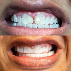 Beautiful-New-Smile Before After