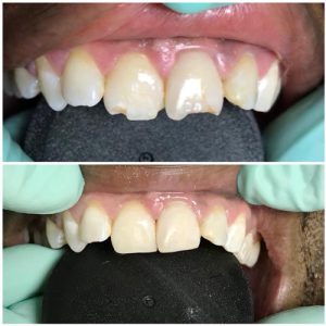 Before and After Broken smile fixed