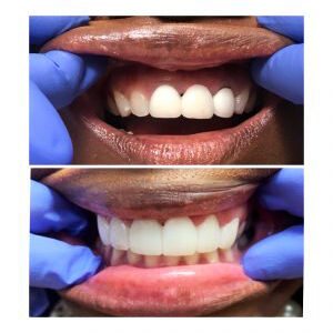 Before and After Whiten and Straighten at Eagle Dental