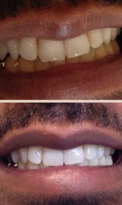 Before and After Whiten Special