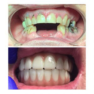 Before and After Smile